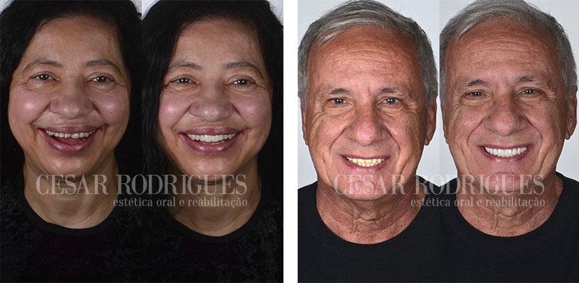 implantes-antes-e-depois